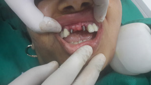 cheap dental implants jalandhar punjab