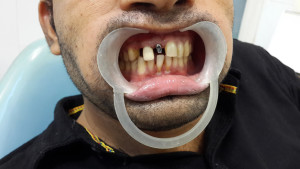 dental Implant india punjab jalandhar