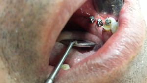 dental implant punjab