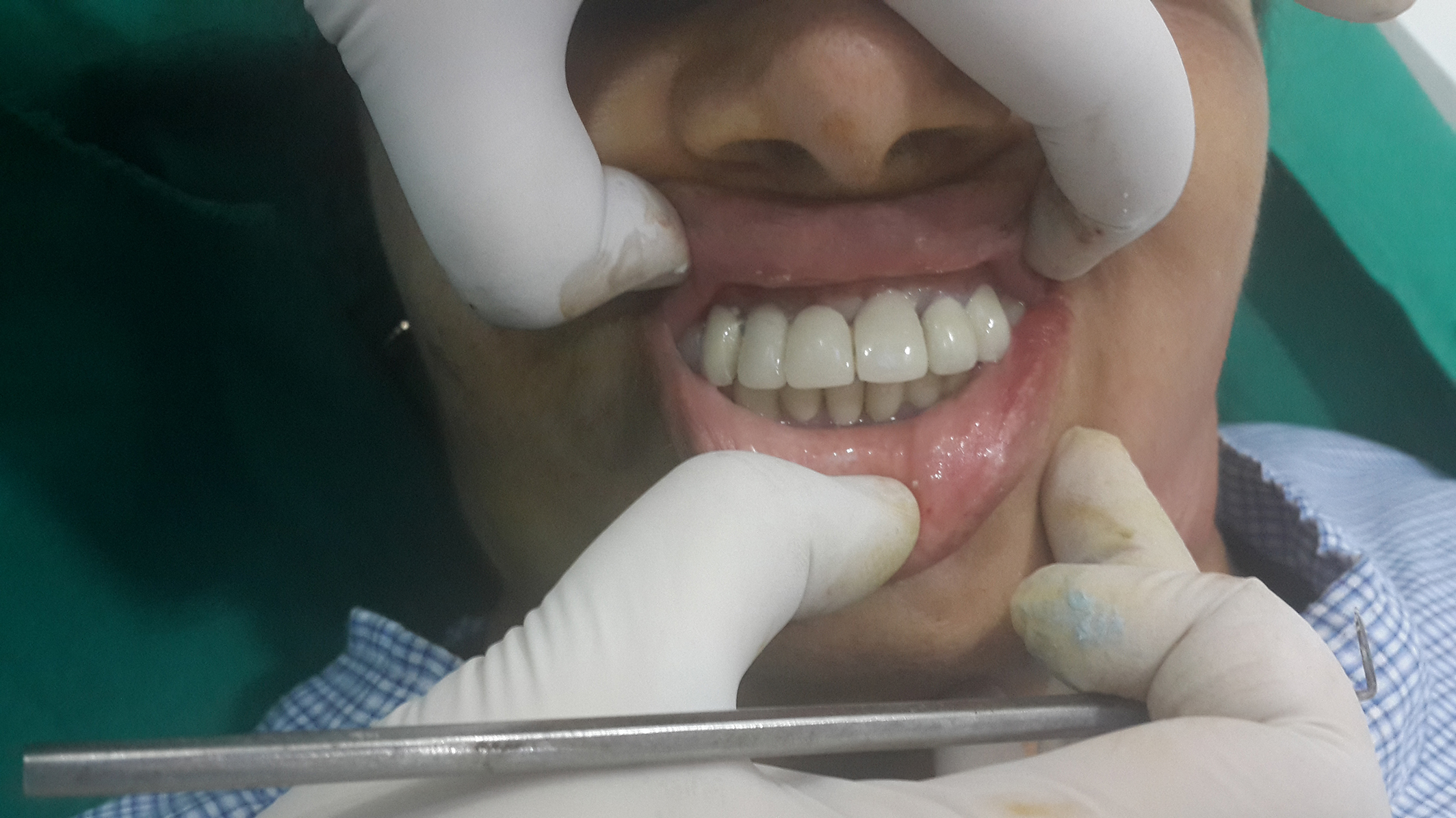 cheap dental implants jalandhar punjab