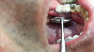 dental implant surgery punjab