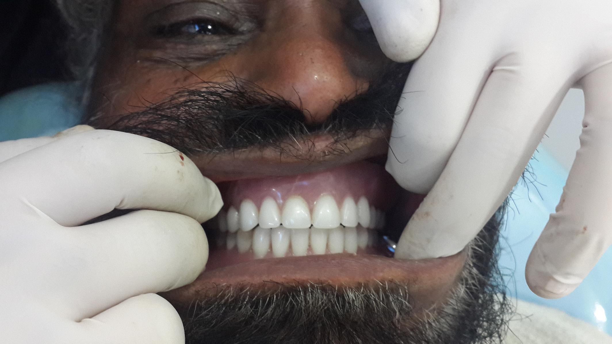 dental implant surgery cost jalandhar punjab