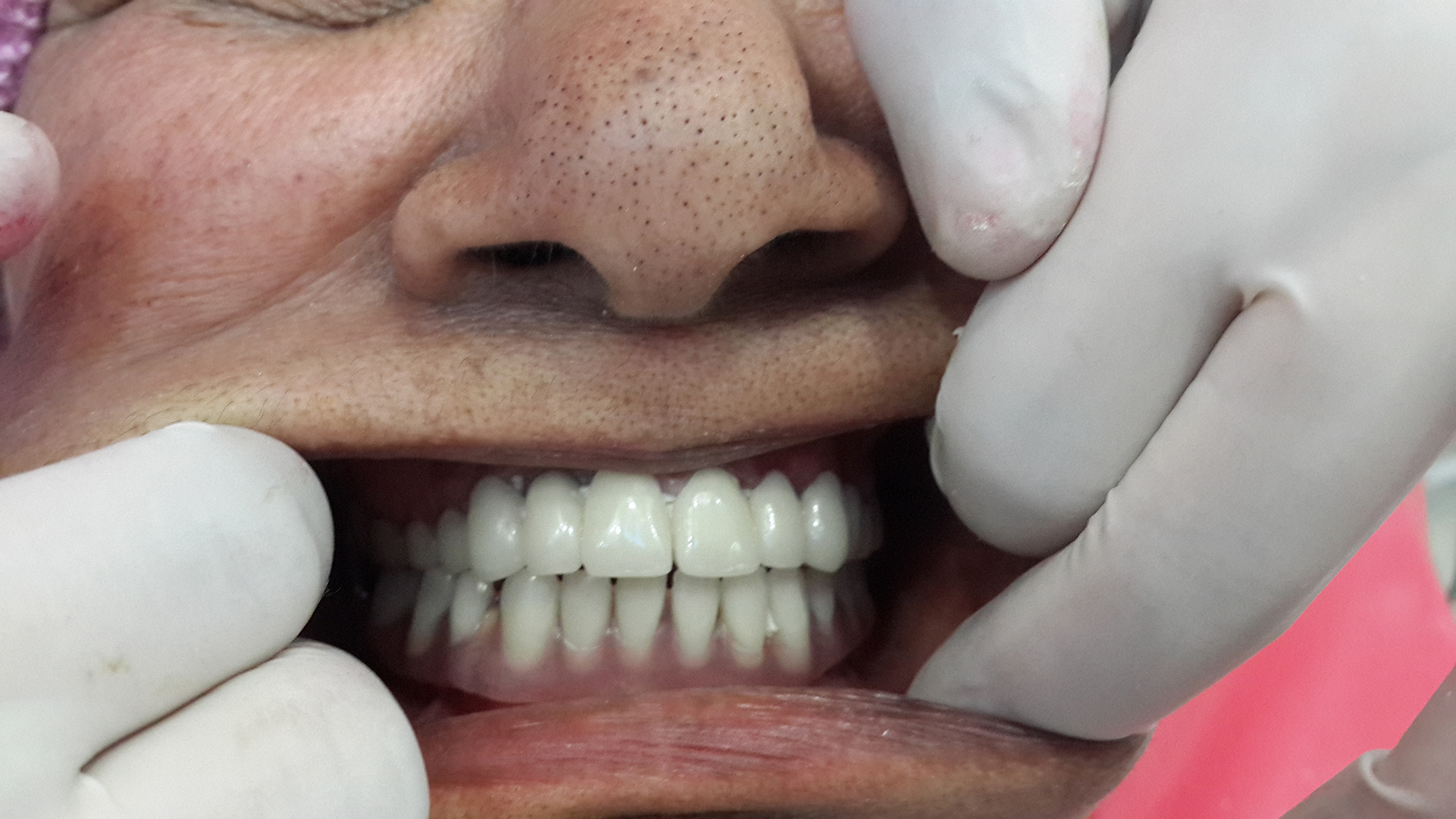 all on four dental implants cost jalandhar punjab india