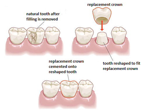 dental crowns cost jalandhar punjab india