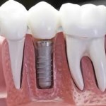 dental implant cost jalandhar punjab