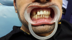 best dental clinic dentist doing idental implants jalandhar punjab india