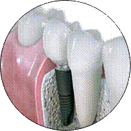dental implant price jalandhar punjab