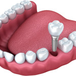 dental implants dental clinic,dentist,dental clinics in jalandhar, punjab,india