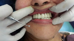 fixed teeth bicortical dental implants in 3 days jalandhar punjab india
