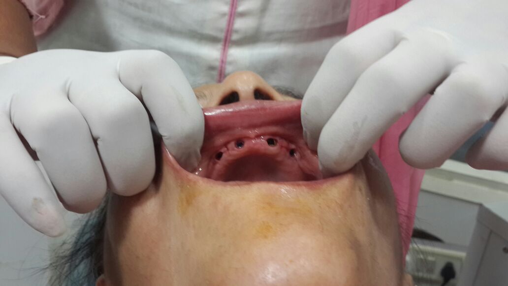 fixed teeth dental implants in just 3 days jalandhar punjab