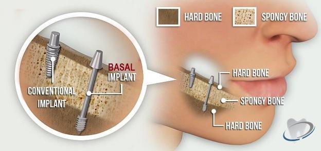 fixed teeth in 3 days basal dental implants jalandhar punjab india