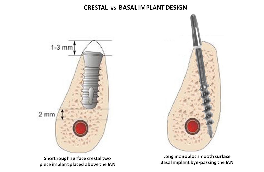  cost of dental implants in 3 days jalandhar punjab india