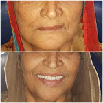 fixed teeth dental implants in just 3 days india punjab