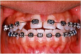 orthodontic treatment braces jalandhar punjab India