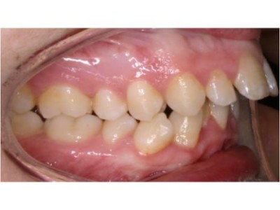 protruded teeth treatment braces