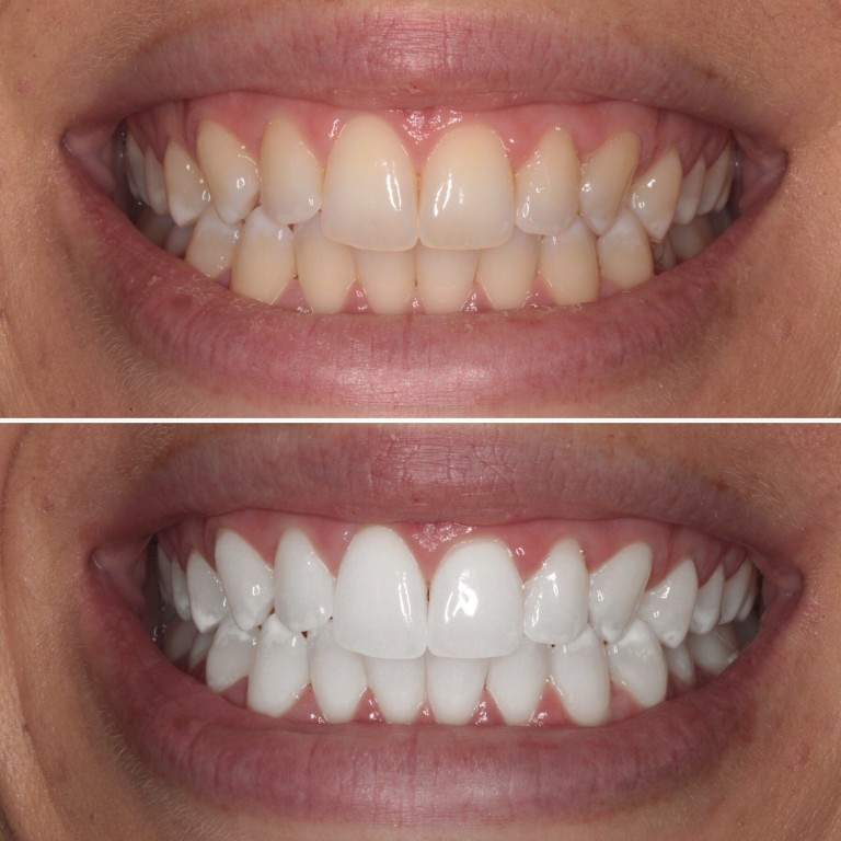 tooth whitening bleaching jalandhar punjab india